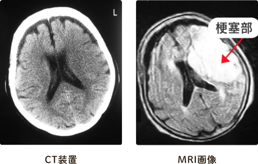 脳梗塞　MRI画像